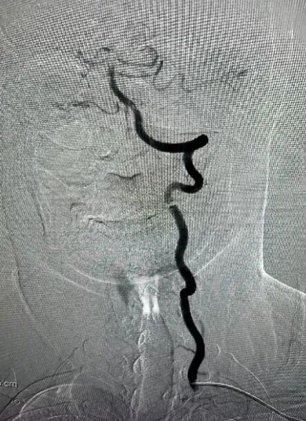 什么叫桡鞘【桡径通神】一例低NIHSS评分，基底动脉闭塞经左桡动脉取栓_https://www.jmylbn.com_新闻资讯_第13张