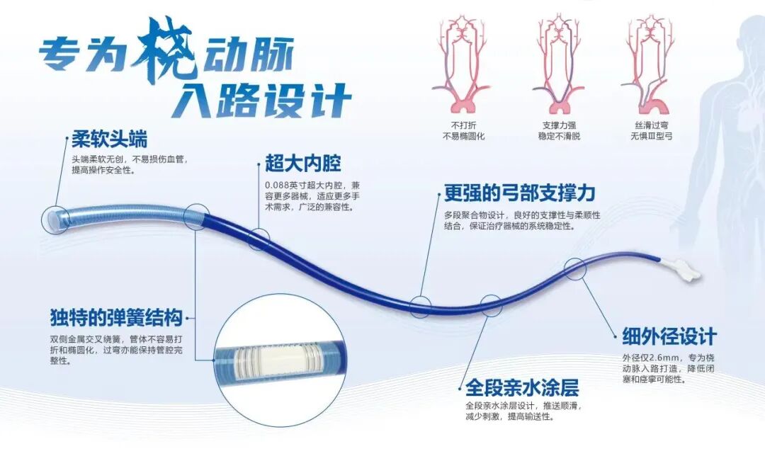 什么叫桡鞘【桡径通神】一例低NIHSS评分，基底动脉闭塞经左桡动脉取栓_https://www.jmylbn.com_新闻资讯_第21张