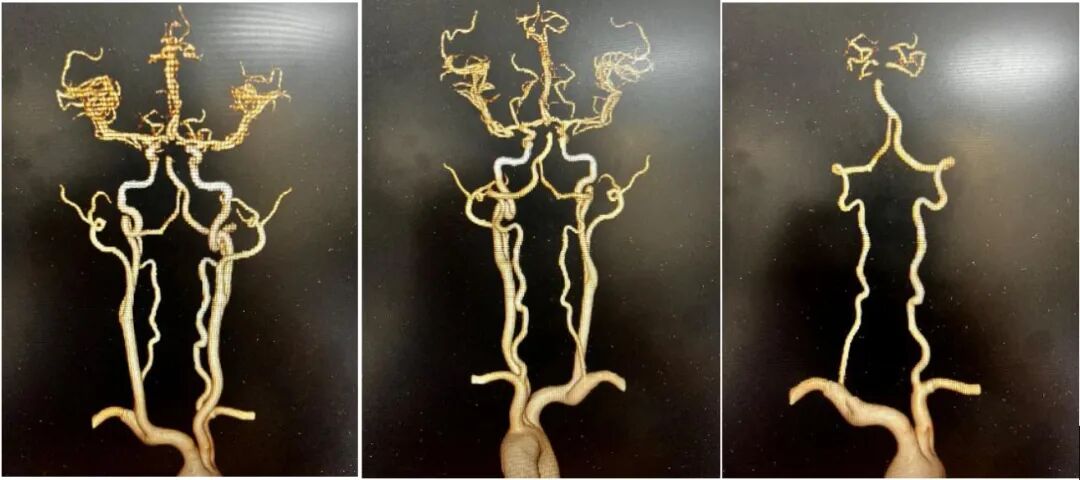 什么叫桡鞘【桡径通神】一例低NIHSS评分，基底动脉闭塞经左桡动脉取栓_https://www.jmylbn.com_新闻资讯_第7张