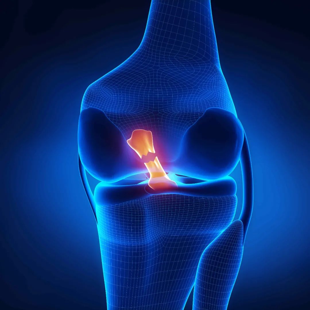 预告膝关节十字韧带损伤为何是运动员职业生涯杀手