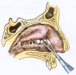 【鼻炎·养护】鼻息肉，只是鼻子里长多块肉吗？