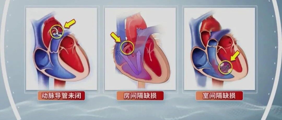 胎儿确诊了先心病该怎么办？来听听专家的建议！