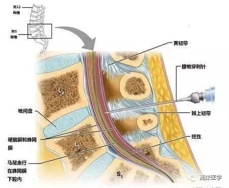中枢神经系统结核病如何鞘内注射糖皮质激素