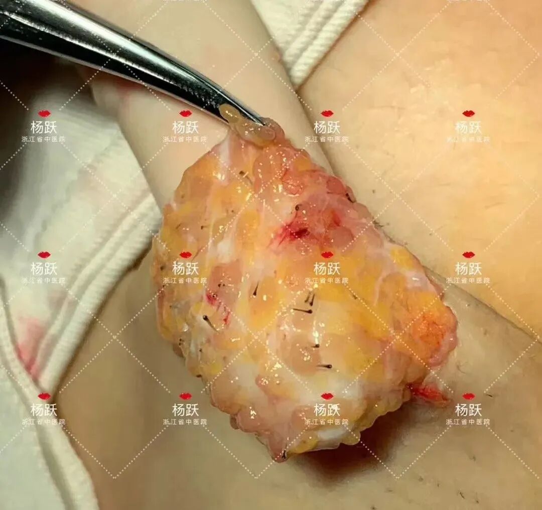 用图片告诉你，腋臭手术是怎么做的，手术需要什么准备，术后会不会有疤痕？腋臭手术全部信息在此。