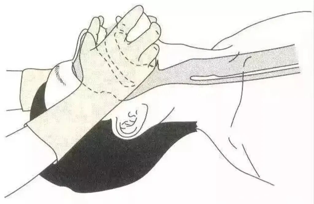 心肺复苏怎么数数字“1001，1002，1003……”是代表心肺复苏按压了1000多次吗？_https://www.jmylbn.com_新闻资讯_第11张