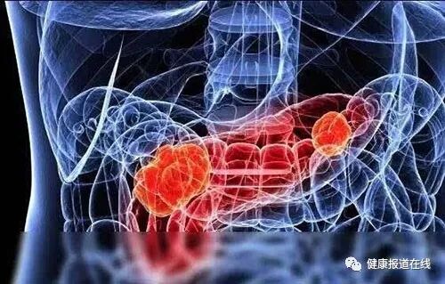 胰腺癌晚期能活多久？胰腺癌晚期的治疗方法推荐