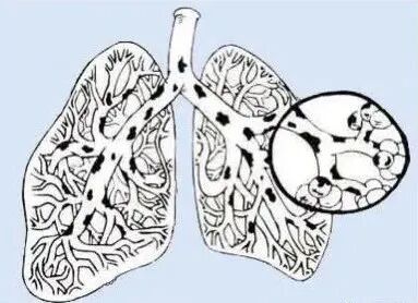 为什么用震动排痰气道廓清之－振动排痰_https://www.jmylbn.com_新闻资讯_第2张