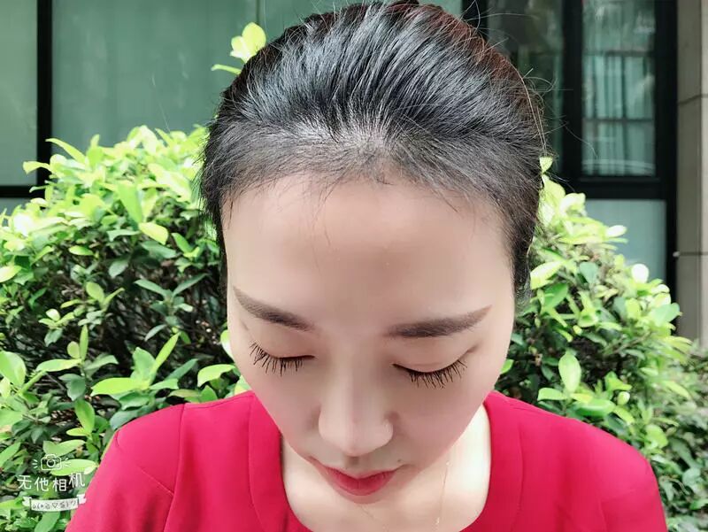 前额头发缺失，发际线种植2000单位，从此让美丽更自信！
