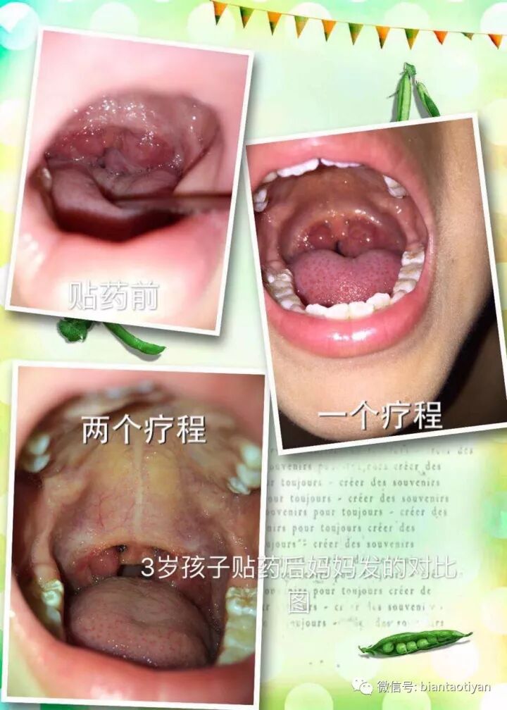 扁桃体总是反复发炎 手术还是保守治疗