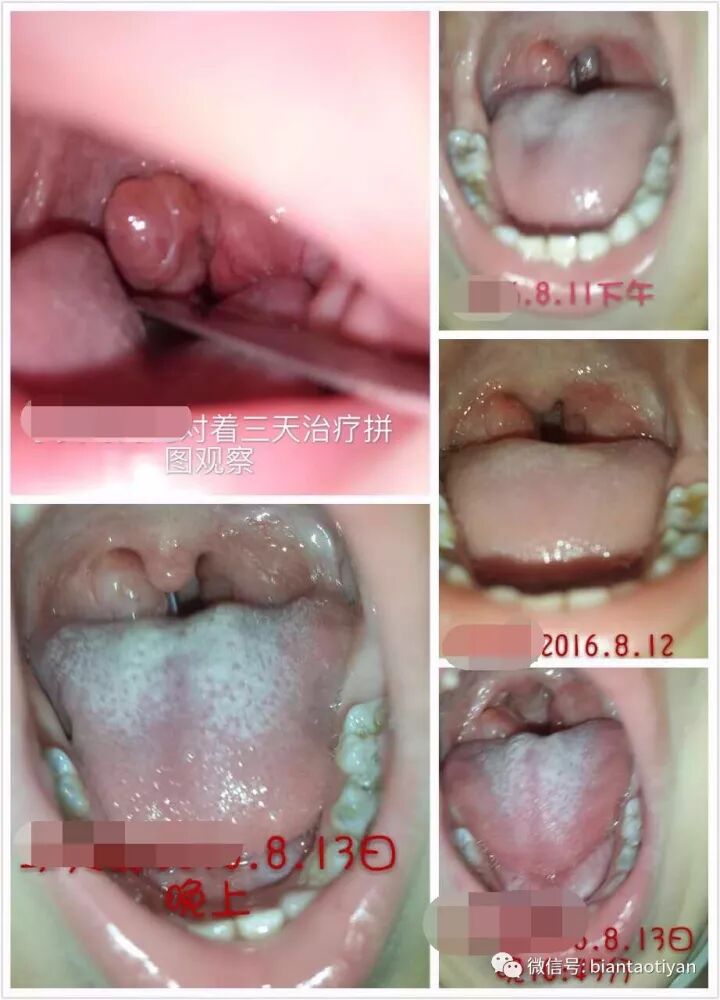 扁桃体总是反复发炎 手术还是保守治疗