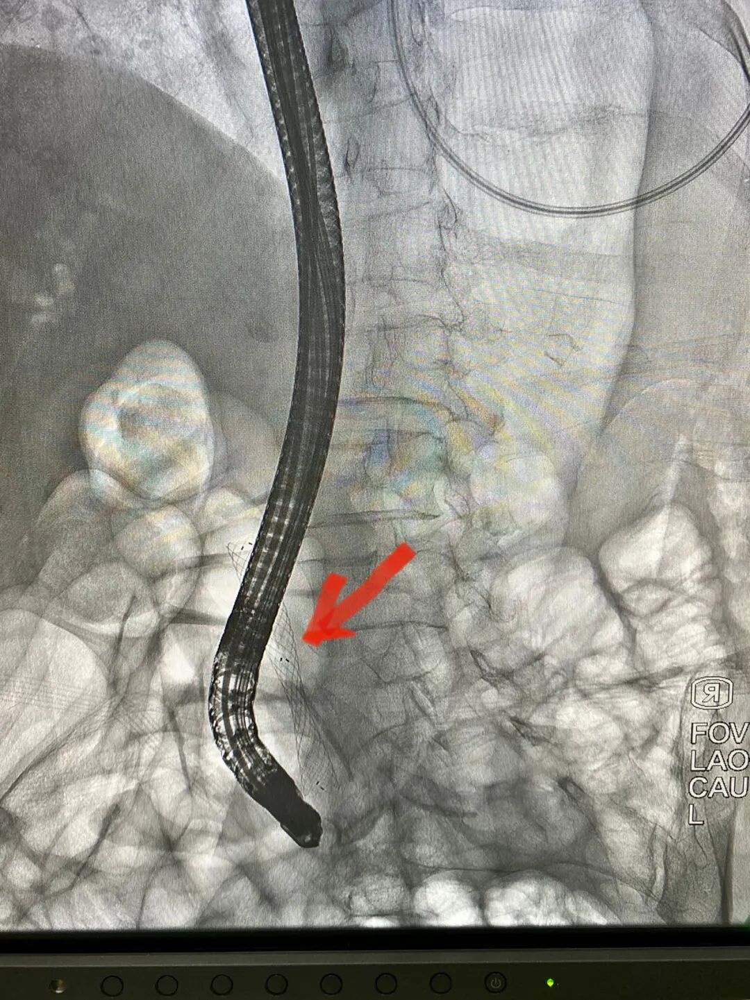 胆什么导管一目了然！胆胰成像导管操作技术——让胆胰管疾病无处遁形！_https://www.jmylbn.com_新闻资讯_第6张