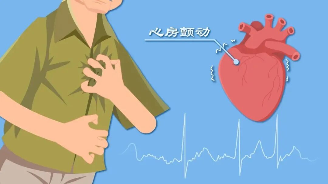 房颤常见的病因包括高血压,冠心病,心力衰竭,心脏外科手术,心肌病