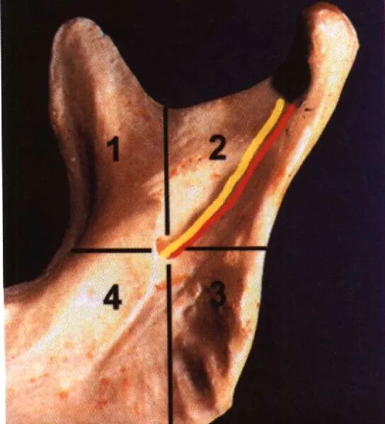 一般下颌孔位于下颌支的中心,如果把下颌支分成4个象限的话,局麻药打