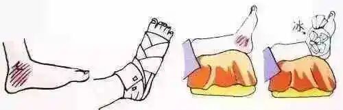 医用绷带怎么绑图解爱运动的青年看过来，这是你需要掌握的踝关节扭伤弹力绷带包扎方法（附视频演示）_https://www.jmylbn.com_新闻资讯_第2张