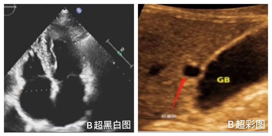 彩超logiq怎么读B超、彩超“傻傻分不清楚”？其实区别就在这！_https://www.jmylbn.com_新闻资讯_第6张