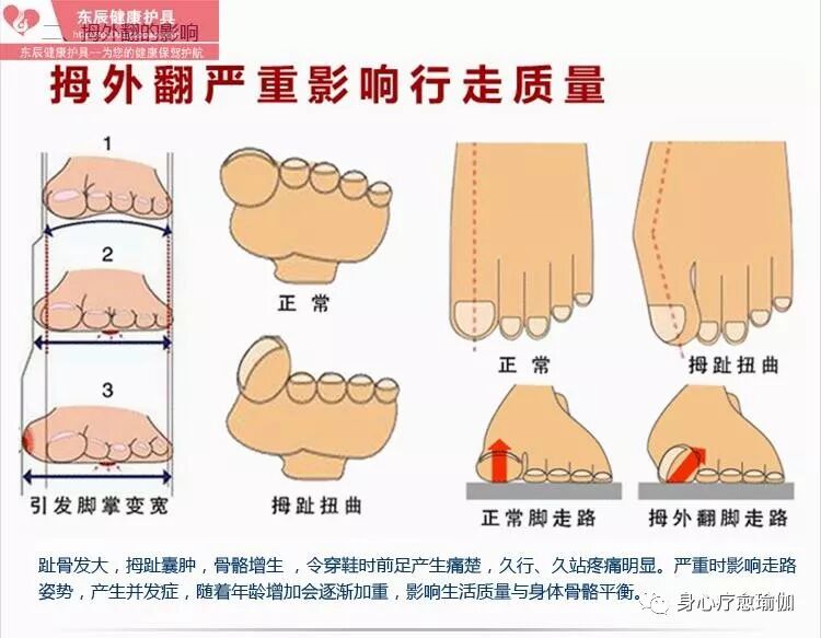 瑜伽脚趾功4步纠正拇外翻