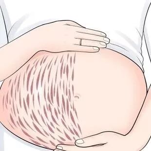 为啥有人生娃不长妊娠纹，而你却有呢？