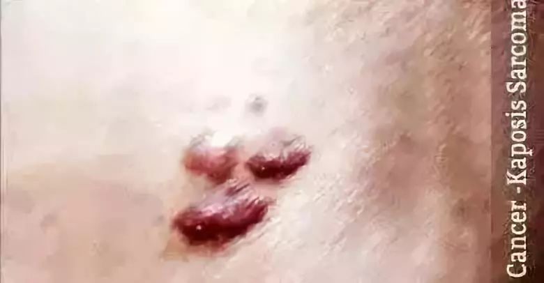 恐怖揭秘：愛滋病「0號病人」是替罪羊？ 靈異 第9張