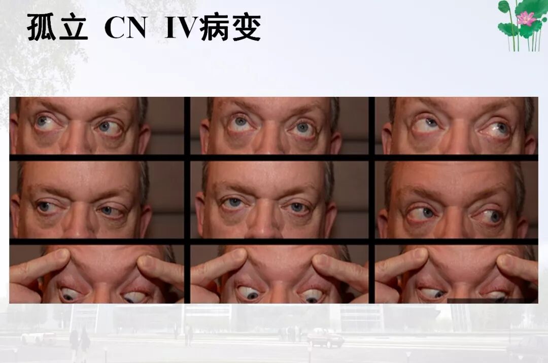 复视的诊断思路,一文读懂_医学界-助力医生临床决策和职业成长