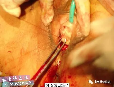 尿道张力过强怎么办TOT无张力尿道悬吊手术讲解（高清图文）_https://www.jmylbn.com_新闻资讯_第14张