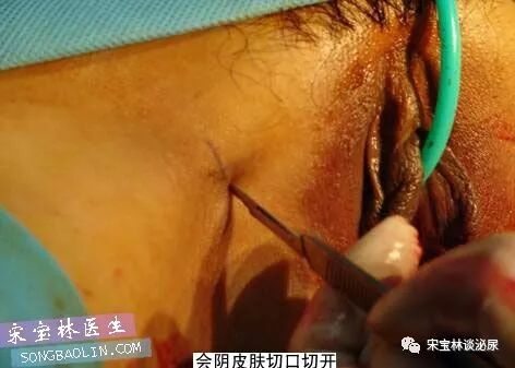 尿道张力过强怎么办TOT无张力尿道悬吊手术讲解（高清图文）_https://www.jmylbn.com_新闻资讯_第8张