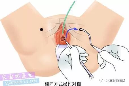 尿道张力过强怎么办TOT无张力尿道悬吊手术讲解（高清图文）_https://www.jmylbn.com_新闻资讯_第10张