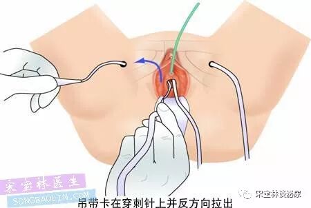 尿道张力过强怎么办TOT无张力尿道悬吊手术讲解（高清图文）_https://www.jmylbn.com_新闻资讯_第11张