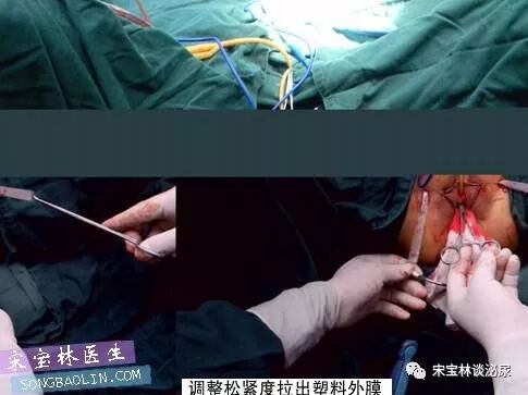 尿道张力过强怎么办TOT无张力尿道悬吊手术讲解（高清图文）_https://www.jmylbn.com_新闻资讯_第12张