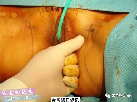 尿道张力过强怎么办TOT无张力尿道悬吊手术讲解（高清图文）_https://www.jmylbn.com_新闻资讯_第5张