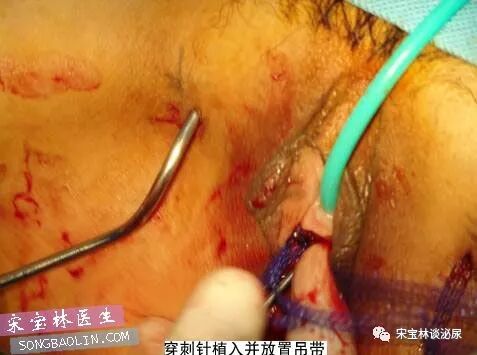 尿道张力过强怎么办TOT无张力尿道悬吊手术讲解（高清图文）_https://www.jmylbn.com_新闻资讯_第9张