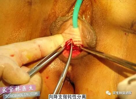 尿道张力过强怎么办TOT无张力尿道悬吊手术讲解（高清图文）_https://www.jmylbn.com_新闻资讯_第7张