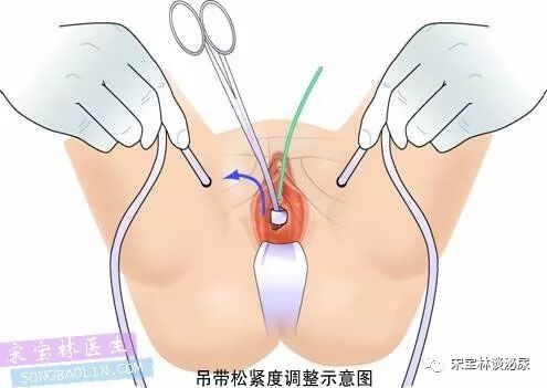 尿道张力过强怎么办TOT无张力尿道悬吊手术讲解（高清图文）_https://www.jmylbn.com_新闻资讯_第13张