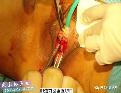 尿道张力过强怎么办TOT无张力尿道悬吊手术讲解（高清图文）_https://www.jmylbn.com_新闻资讯_第6张