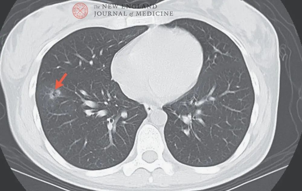 患者月经期反复咳血肺部有磨玻璃状的空洞结节考虑是