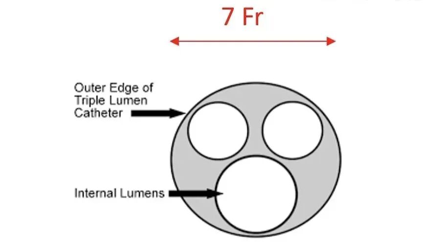 fr导管单位怎么读导管直径“French”的历史及含义_https://www.jmylbn.com_新闻资讯_第4张