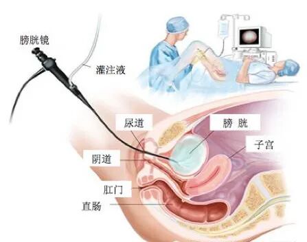 b膀胱镜为什么消毒【科普视频】三分钟带你了解膀胱镜检查的那些事儿_https://www.jmylbn.com_新闻资讯_第2张