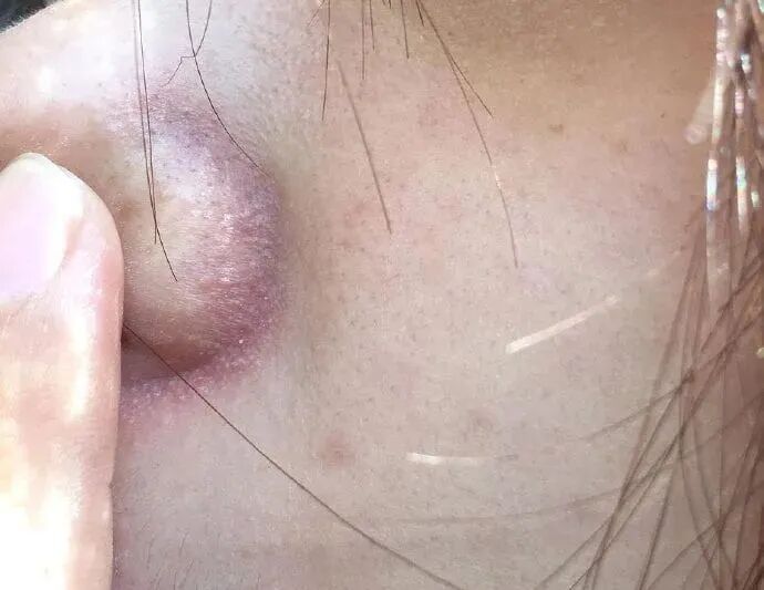 鼻翼泛红起屑？当心是脂溢性皮炎！