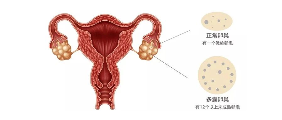 多囊不孕，我该怎么办啊？我还能做妈妈吗？