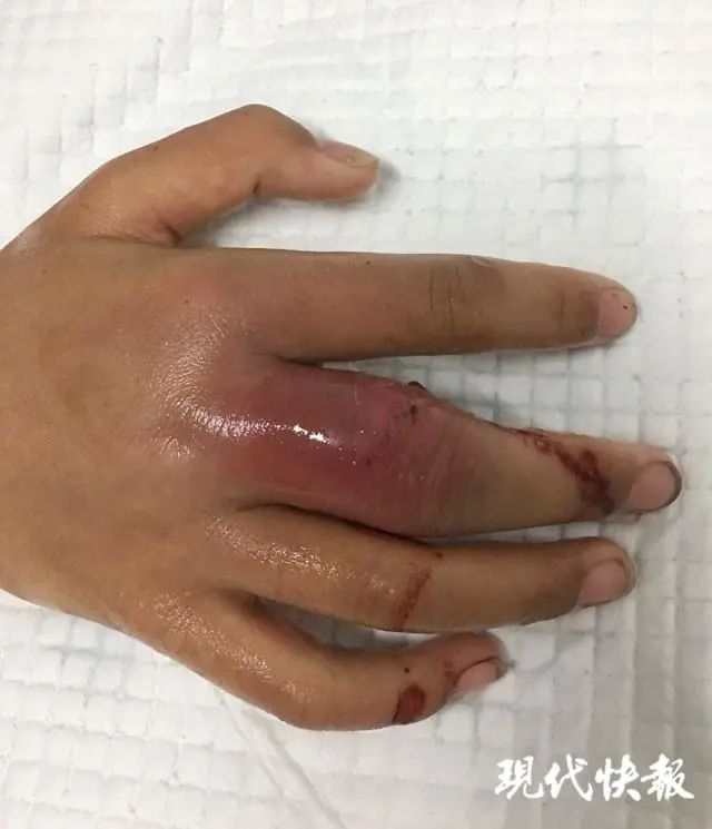 【提醒】与它握了个手,男子手指红肿溃烂!医生:别大意