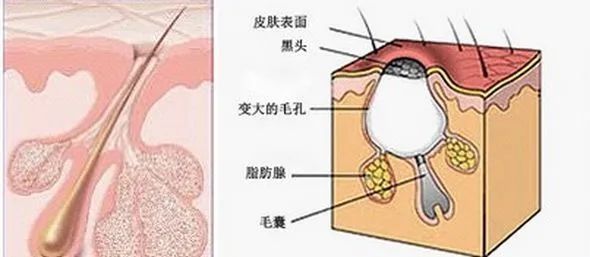 頭皮毛囊炎又腫又痛究竟是什麼原因導致反反覆覆