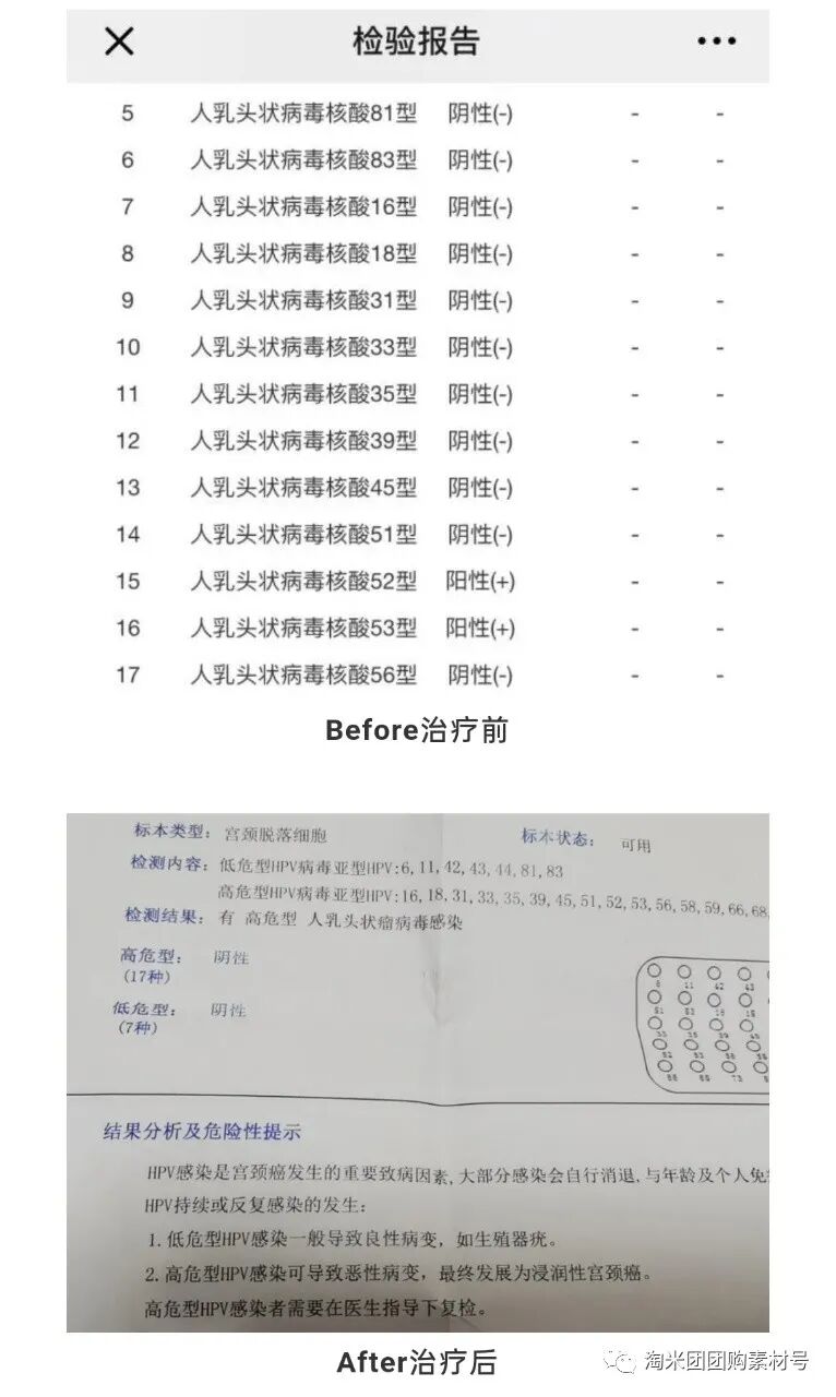 妇科蛋白膜怎么用【医师推荐】国药集团抗HPV生物蛋白妇科凝胶 ｜ 阻断HPV感染，恢复私处年轻态_https://www.jmylbn.com_新闻资讯_第49张