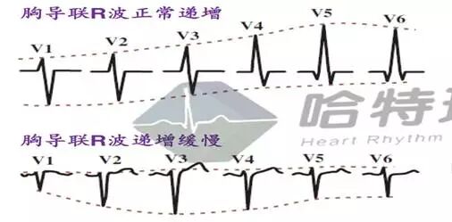 心电图怎么切换导联原来读懂心电图可以如此简单！_https://www.jmylbn.com_新闻资讯_第25张