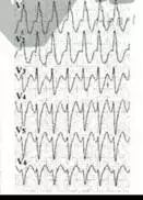 心电图怎么切换导联原来读懂心电图可以如此简单！_https://www.jmylbn.com_新闻资讯_第20张
