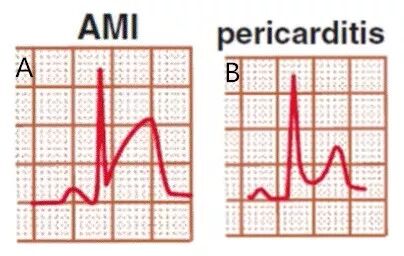 心电图怎么切换导联原来读懂心电图可以如此简单！_https://www.jmylbn.com_新闻资讯_第34张