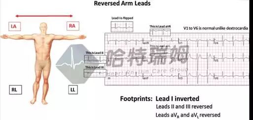 心电图怎么切换导联原来读懂心电图可以如此简单！_https://www.jmylbn.com_新闻资讯_第13张