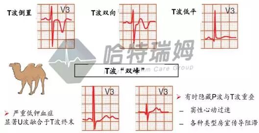 心电图怎么切换导联原来读懂心电图可以如此简单！_https://www.jmylbn.com_新闻资讯_第29张