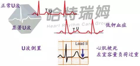 心电图怎么切换导联原来读懂心电图可以如此简单！_https://www.jmylbn.com_新闻资讯_第30张