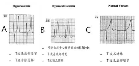 心电图怎么切换导联原来读懂心电图可以如此简单！_https://www.jmylbn.com_新闻资讯_第28张