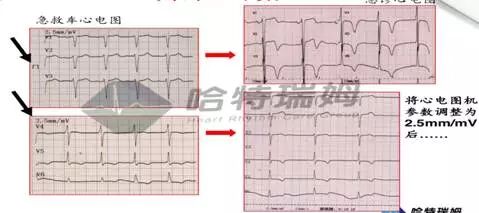 心电图怎么切换导联原来读懂心电图可以如此简单！_https://www.jmylbn.com_新闻资讯_第12张