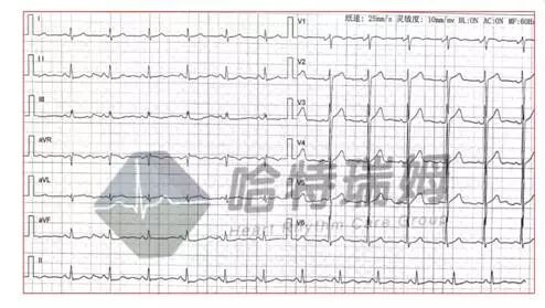 心电图怎么切换导联原来读懂心电图可以如此简单！_https://www.jmylbn.com_新闻资讯_第6张